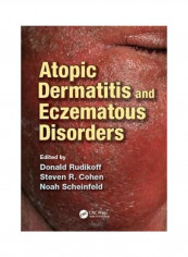 Atopic Dermatitis And Eczematous Disorders Hardcover English by Donald Rudikoff