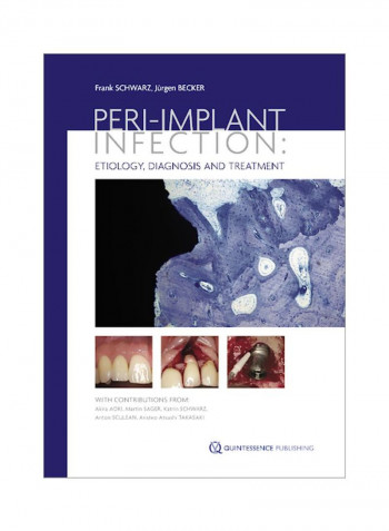 Peri-Implant Infection: Etiology, Diagnosis And Treatment Paperback