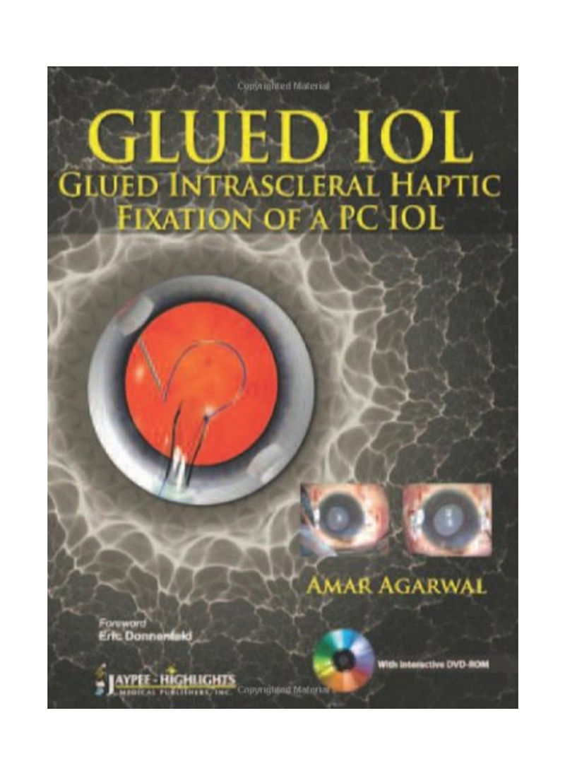 GLUED IOL : Glued Intrascleral Haptic Fixation of a PC IOL Paperback 1