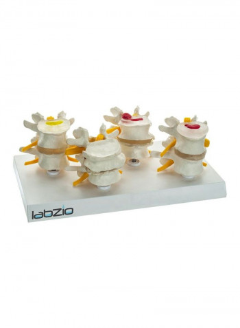 4-Stage Vertebrae Diseases Model Kit LZ0025