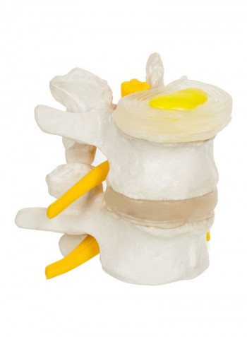 4-Stage Vertebrae Diseases Model Kit LZ0025